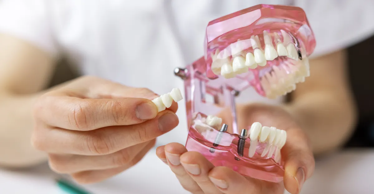 Dental Implants in Grapevine: A Complete Guide to the Process