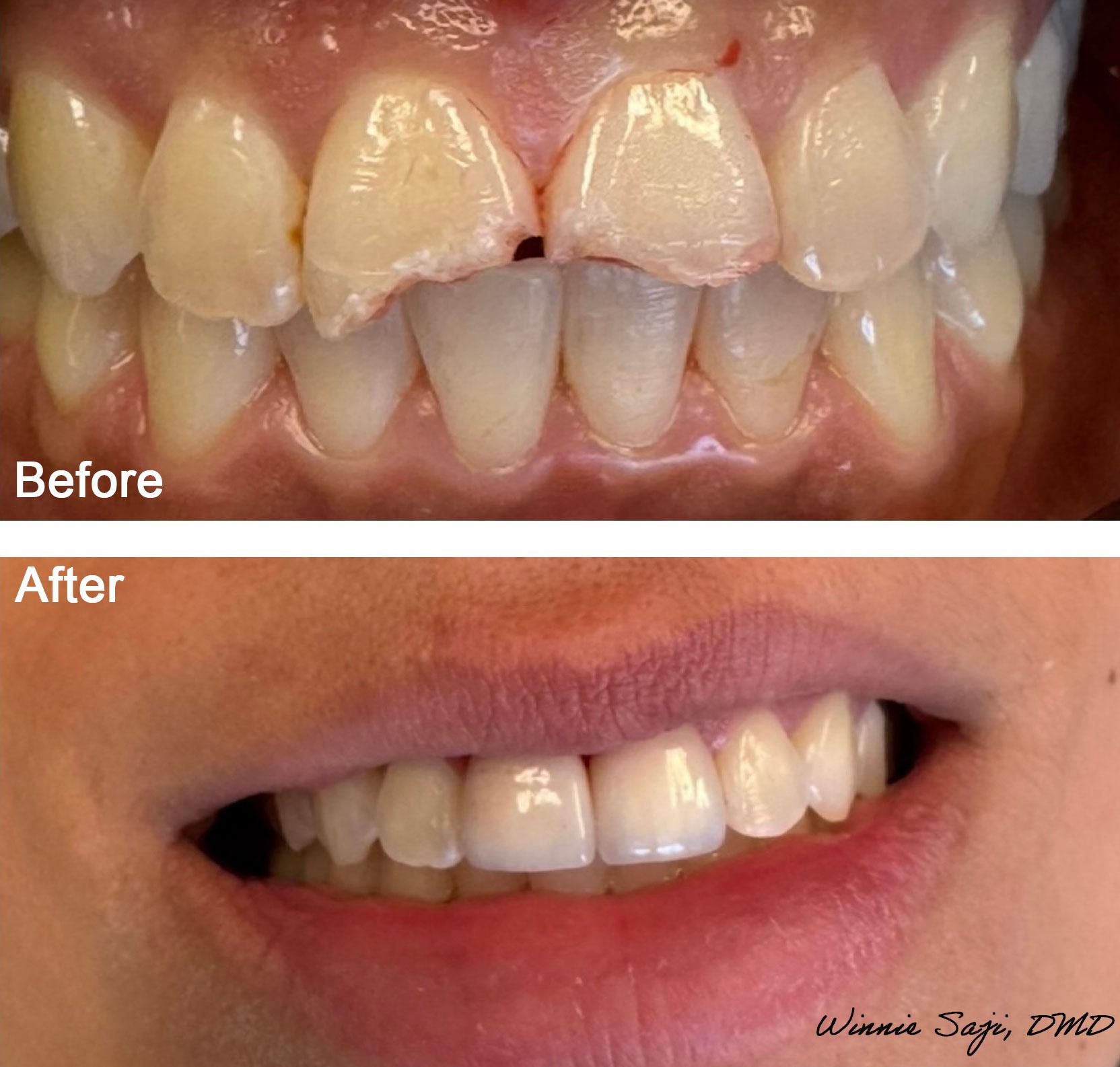 When a dental emergency happens, call Smile Win Dental in Grapevine, TX