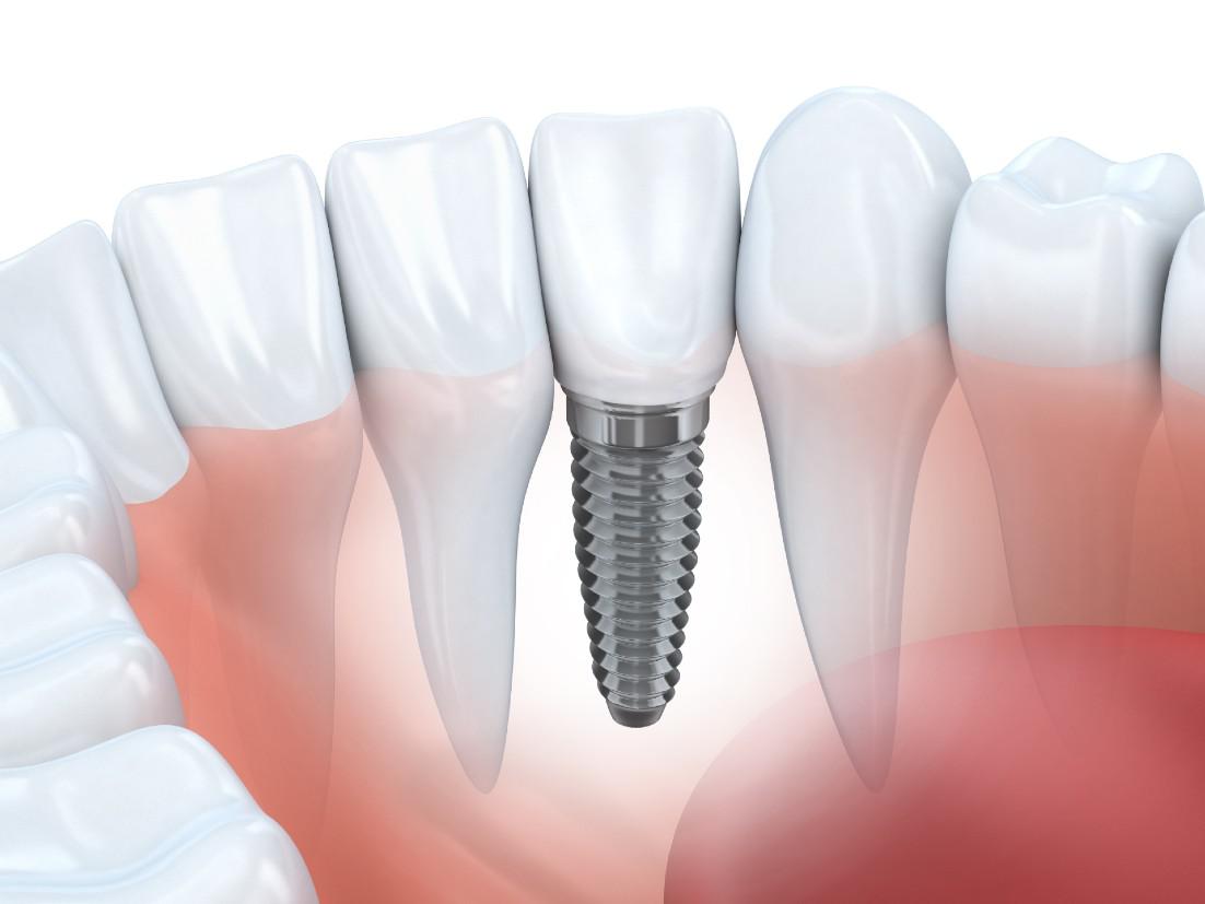 Dental Implants Grapevine, TX